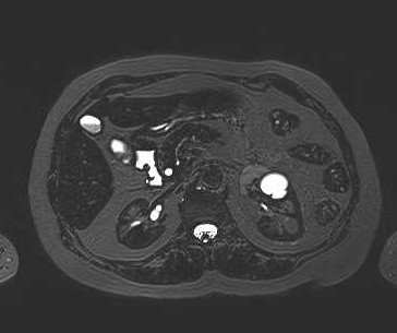 File:Adenomyomatosis of the gallbladder (Radiopaedia 50246-55587 Axial 40).png