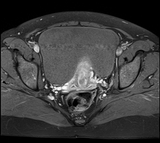 File:Adenomyosis - ovarian endometriomas (Radiopaedia 67031-76350 Axial T1 C+ fat sat 18).jpg