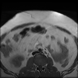 File:Adenomyosis within a didelphys uterus (Radiopaedia 70175-80215 Axial T1 1).jpg