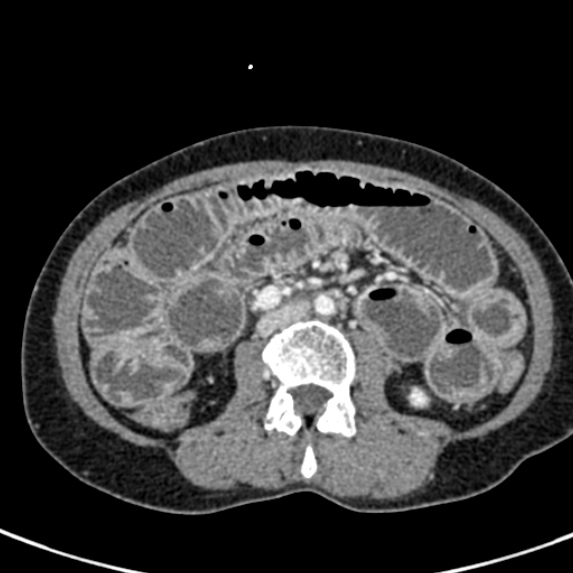 Adhesional small bowel obstruction (Radiopaedia 48397-53305 Axial C+ portal venous phase 40).jpg