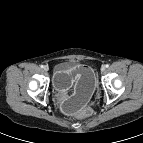 Adhesional small bowel obstruction (Radiopaedia 48397-53305 Axial C+ portal venous phase 85).jpg