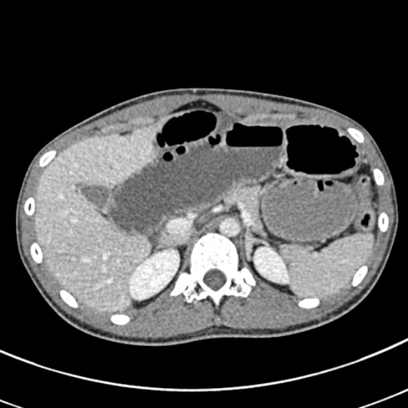 File:Adhesional small bowel obstruction (Radiopaedia 52107-57980 Axial C+ portal venous phase 29).jpg