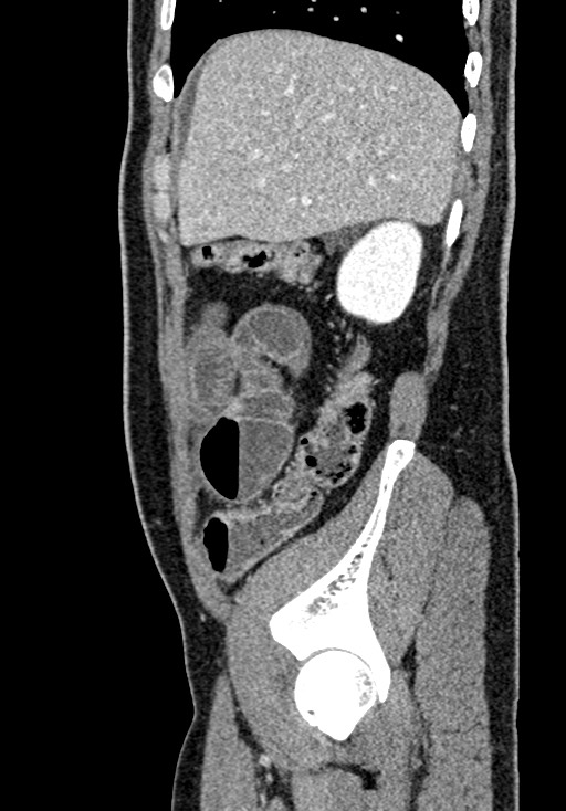 Adhesional small bowel obstruction (Radiopaedia 58900-66131 Sagittal C+ portal venous phase 55).jpg
