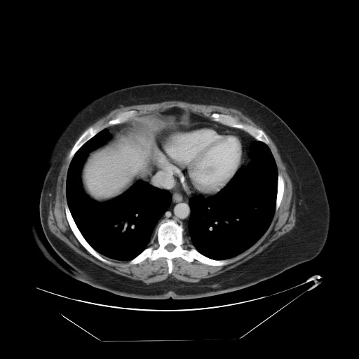 Adrenal angiosarcoma (Radiopaedia 81081-94671 Axial C+ portal venous phase 5).jpg
