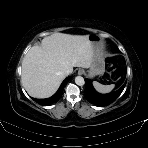 Adrenal cortical carcinoma (Radiopaedia 64017-72769 Axial C+ portal venous phase 10).jpg