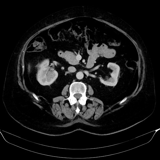 File:Adrenal cortical carcinoma (Radiopaedia 64017-72769 Axial C+ portal venous phase 29).jpg