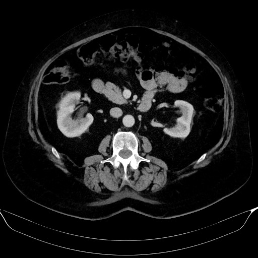 Adrenal cortical carcinoma (Radiopaedia 64017-72769 Axial C+ portal venous phase 30).jpg