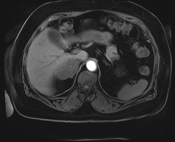 Adrenal cortical carcinoma (Radiopaedia 64017-72770 Axial T1 C+ fat sat 5).jpg