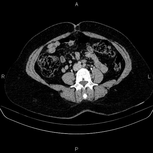 Adrenal cortical carcinoma (Radiopaedia 84882-100379 Axial C+ delayed 54).jpg