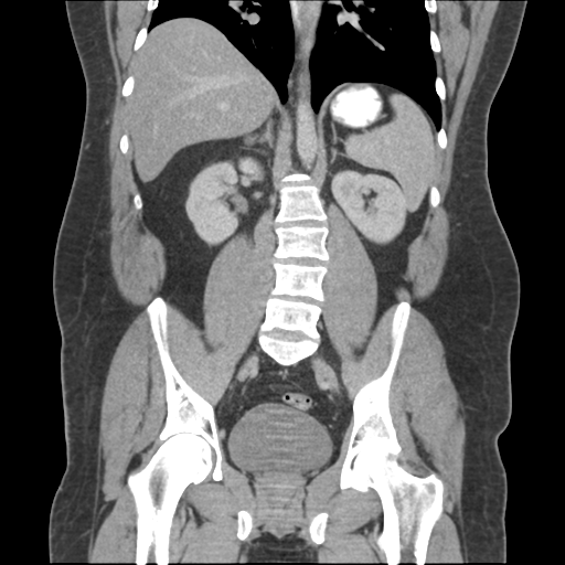 Adrenal cyst (Radiopaedia 45625-49776 Coronal C+ portal venous phase 46).png