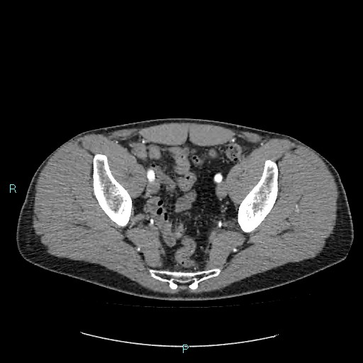Adrenal cystic lymphangioma (Radiopaedia 83161-97534 Axial C+ arterial phase 84).jpg