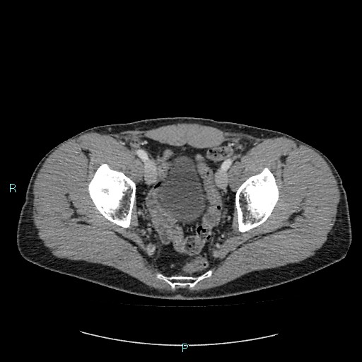 File:Adrenal cystic lymphangioma (Radiopaedia 83161-97534 Axial C+ portal venous phase 88).jpg