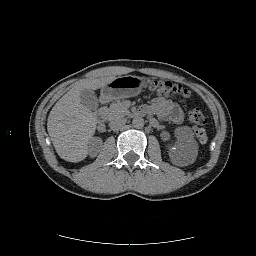 Adrenal cystic lymphangioma (Radiopaedia 83161-97534 Axial non-contrast 37).jpg