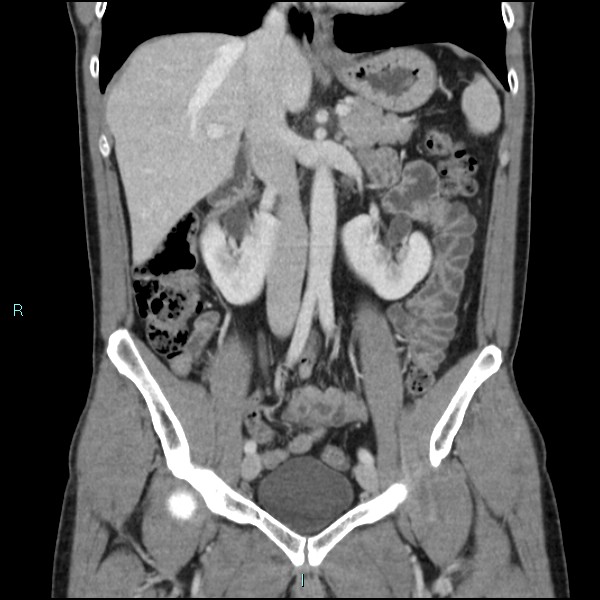 Adrenal cystic lymphangioma (Radiopaedia 83161-97534 Coronal C+ portal venous phase 35).jpg