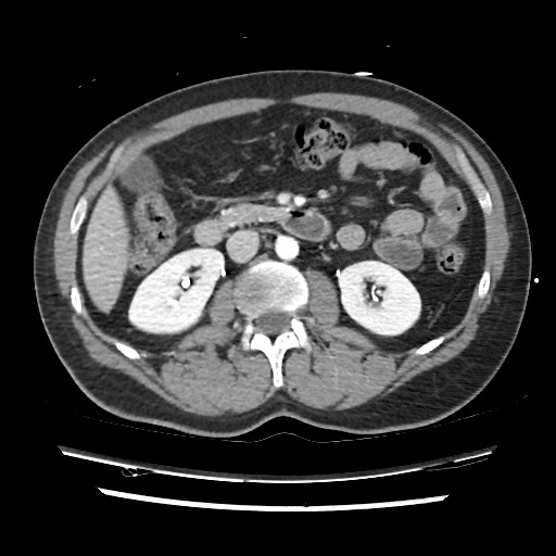 Adrenal gland trauma (Radiopaedia 81351-95078 Axial Dual bolus trauma C+ 74).jpg