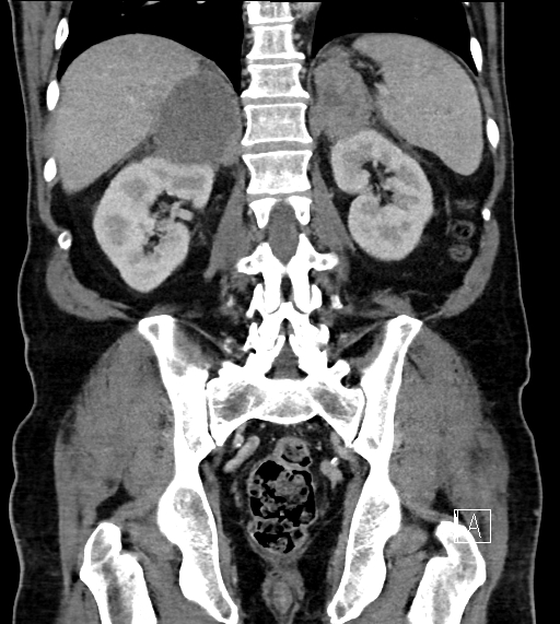 Adrenal lymphoma (Radiopaedia 73730-84529 Coronal C+ portal venous phase 57).jpg