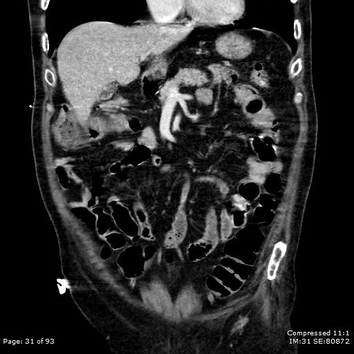 Adrenal metastasis (Radiopaedia 78425-91079 Sagittal C+ portal venous phase 18).jpg