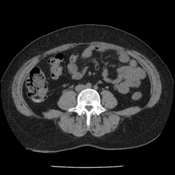 Adrenal myelolipoma (Radiopaedia 43401-46759 Axial non-contrast 51).jpg