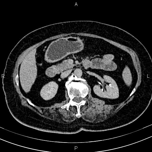 Adrenal myelolipoma (Radiopaedia 82742-96986 Axial renal excretory phase 57).jpg