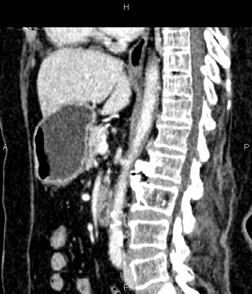 Adrenal myelolipoma (Radiopaedia 82742-96986 Sagittal renal cortical phase 56).jpg