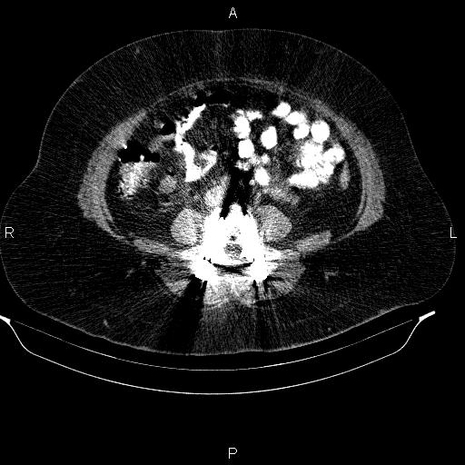 File:Adrenal myelolipoma (Radiopaedia 84319-99617 Axial renal cortical phase 69).jpg