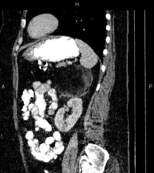 Adrenal myelolipoma (Radiopaedia 84319-99617 Sagittal renal cortical phase 69).jpg