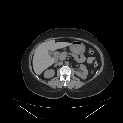 Adrenal myelolipoma - MRI (Radiopaedia 83249-97647 Axial non-contrast 51).jpg