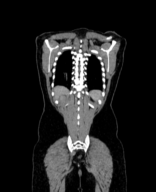 Adrenocortical carcinoma (Radiopaedia 80134-93438 Coronal C+ portal venous phase 142).jpg