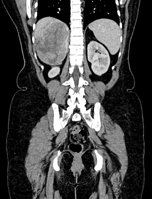 Adrenocortical carcinoma (Radiopaedia 87281-103569 Coronal C+ portal venous phase 103).jpg
