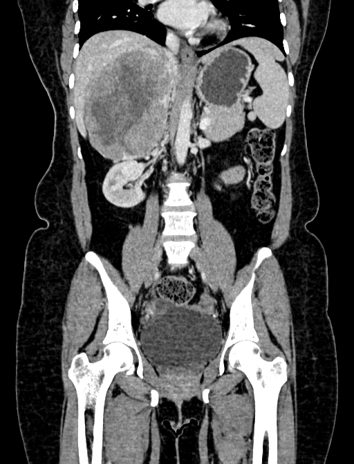 Adrenocortical carcinoma (Radiopaedia 87281-103569 Coronal C+ portal venous phase 58).jpg