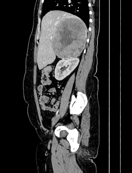 Adrenocortical carcinoma (Radiopaedia 87281-103569 Sagittal C+ portal venous phase 86).jpg