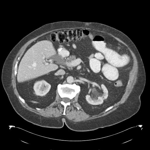 Adult ileal intussusception with secondary obstruction (Radiopaedia 30395-31051 Axial C+ portal venous phase 27).jpg