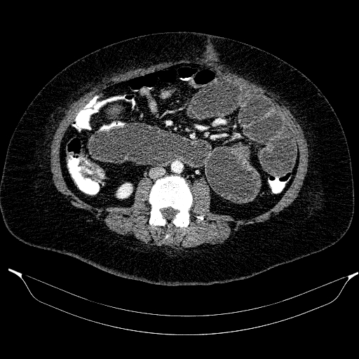 Afferent loop syndrome - secondary to incarcerated trocar site hernia (Radiopaedia 82959-97305 Axial C+ portal venous phase 125).jpg