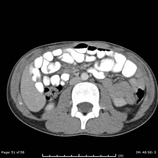 File:Agenesis of the gallbladder (Radiopaedia 55454-61905 B 51).jpg