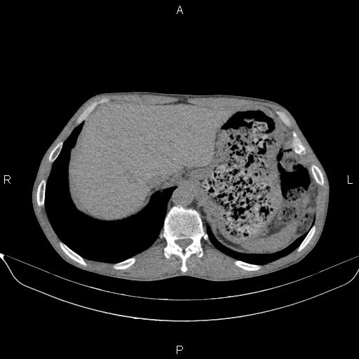 Air bronchogram in pneumonia (Radiopaedia 85719-101512 Axial non-contrast 62).jpg