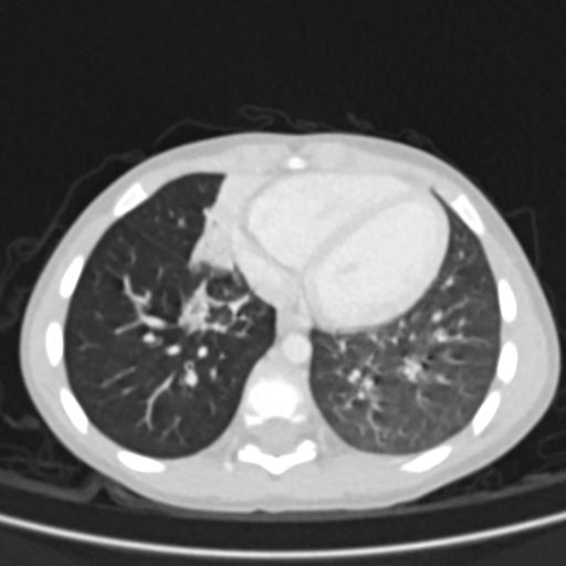 Airway foreign body (Radiopaedia 72128-82638 Axial lung window 64).jpg