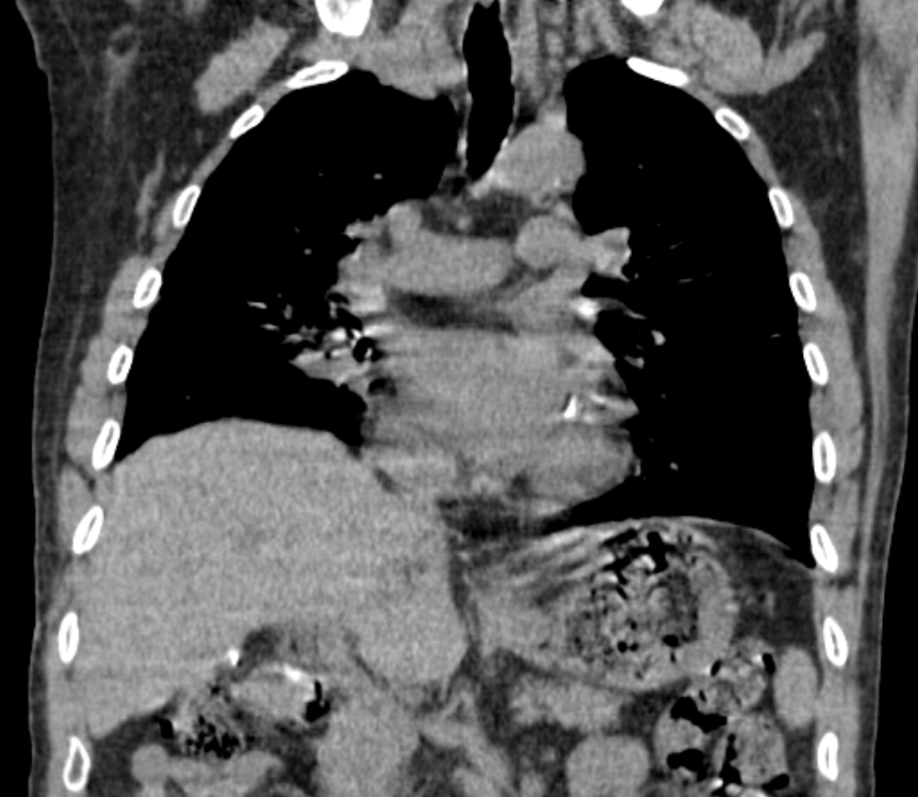 Airway foreign body in adult (Radiopaedia 85907-101779 Coronal liver window 125).jpg