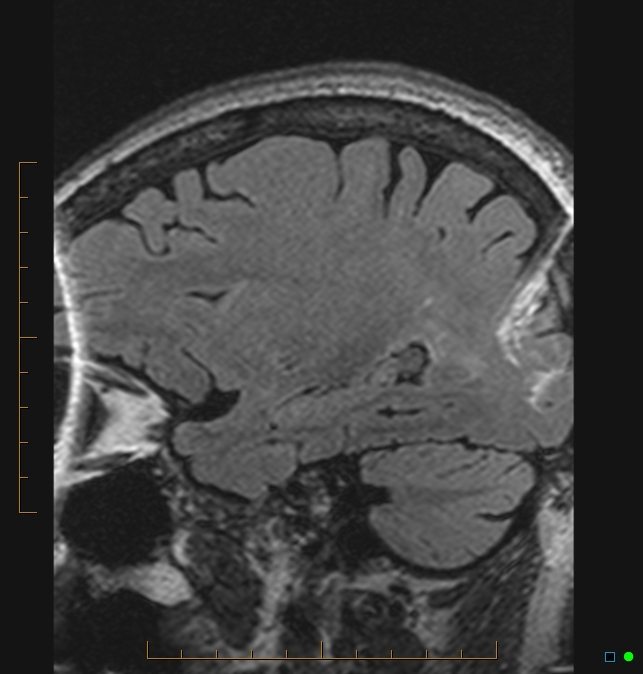 Aliasing artifact causing a spurious cerebellar lesion (Radiopaedia 48783-53810 Sagittal FLAIR 92).jpg