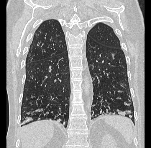 Alpha-1-antitrypsin deficiency (Radiopaedia 72058-82557 Coronal lung window 74).jpg