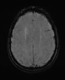 File:Alzheimer's disease- with Gerstmann syndrome and dressing apraxia (Radiopaedia 54882-61150 Axial SWI 25).png