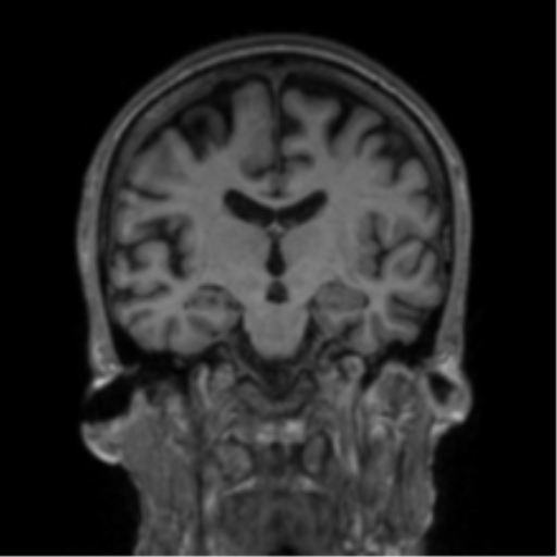 File:Alzheimer's disease- with apraxia (Radiopaedia 54763-61011 Coronal T1 49).png