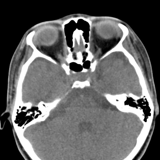File:Ameloblastoma (Radiopaedia 26645-26793 Axial C+ delayed 42).jpg