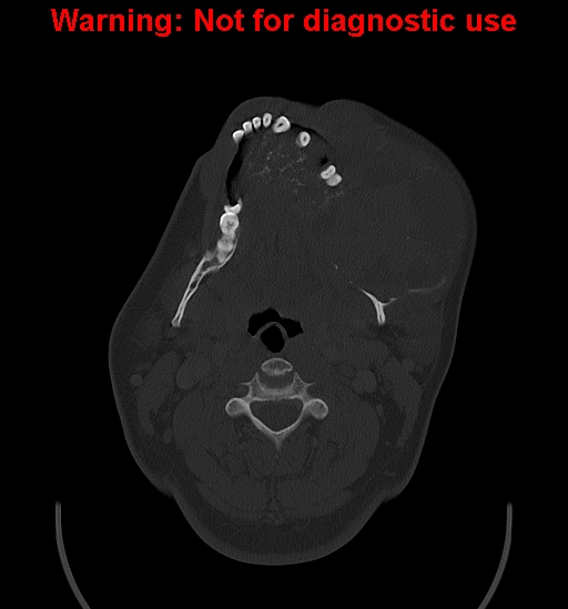 Ameloblastoma (Radiopaedia 33126-34164 Axial bone window 14).jpg