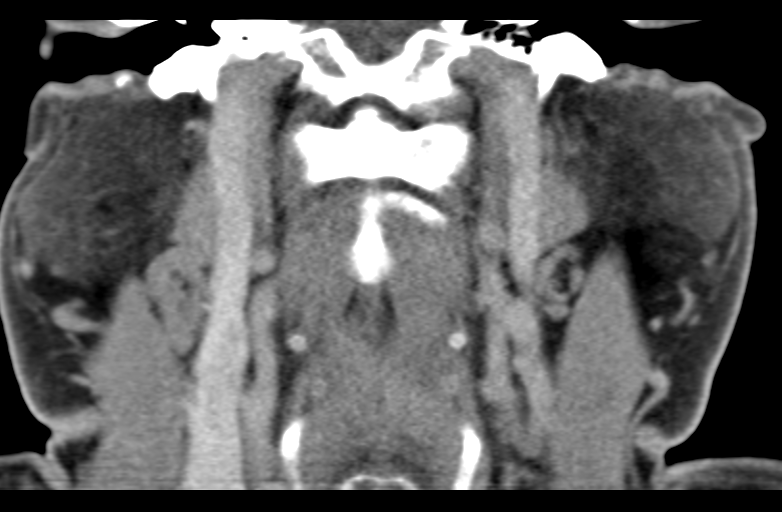 Ameloblastoma (Radiopaedia 33677-34806 Coronal non-contrast 44).png