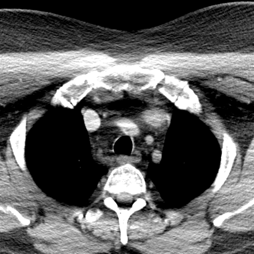 Ameloblastoma (Radiopaedia 38520-40623 Axial non-contrast 81).png