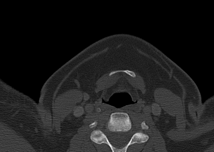 Ameloblastoma (Radiopaedia 38520-40623 D 48).png
