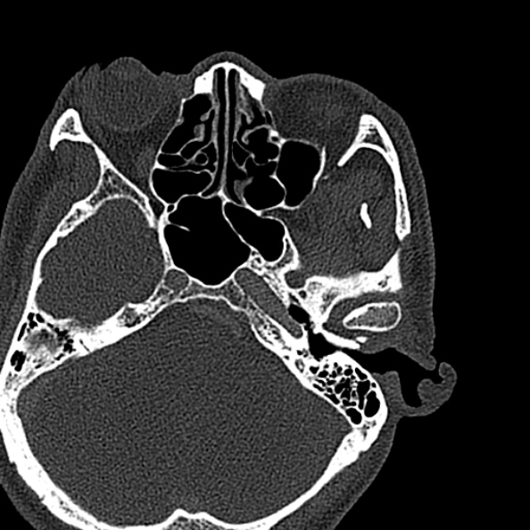Ameloblastoma (Radiopaedia 51921-57766 Axial bone window 158).jpg