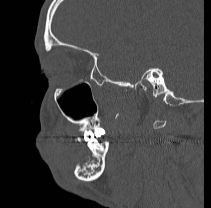 Ameloblastoma (Radiopaedia 77750-89997 Sagittal bone window 56).jpg