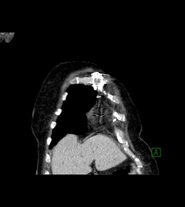 Amiodarone deposition in the liver (Radiopaedia 77587-89780 Coronal non-contrast 16).jpg