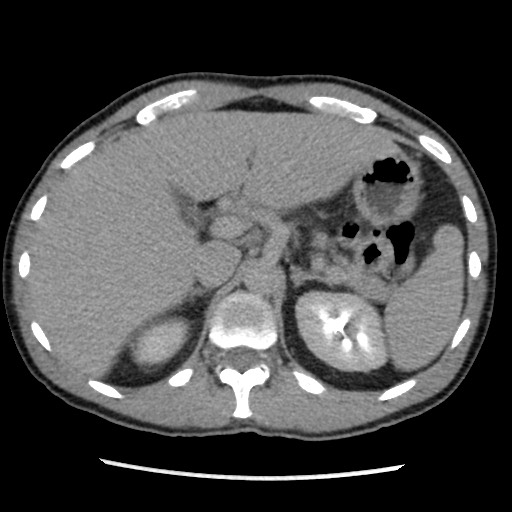 Amoebic liver abscesses (Radiopaedia 55536-62009 Axial C+ delayed 28).jpg
